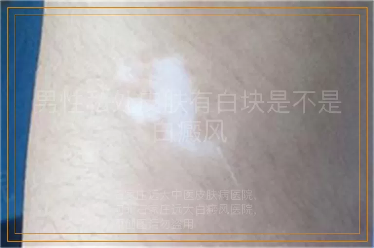 男性私处皮肤有白块是不是白癜风