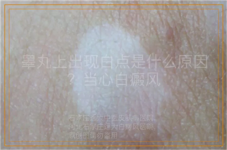 睾丸上出现白点是什么原因？当心白癜风