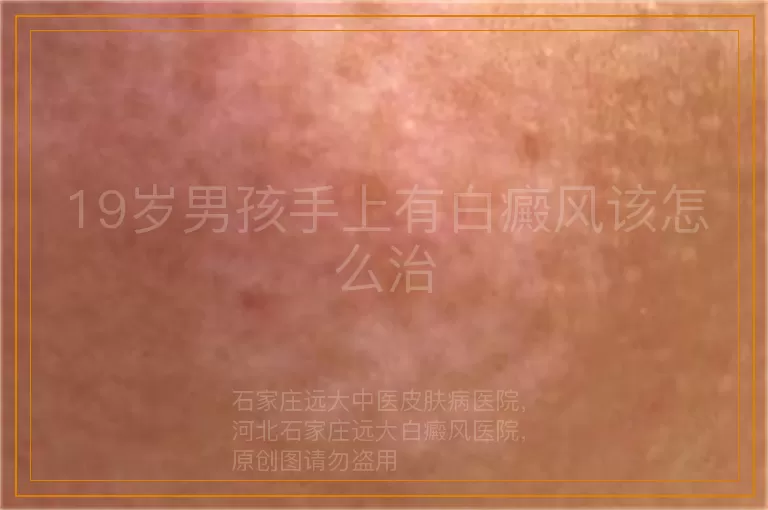 19岁男孩手上有白癜风该怎么治