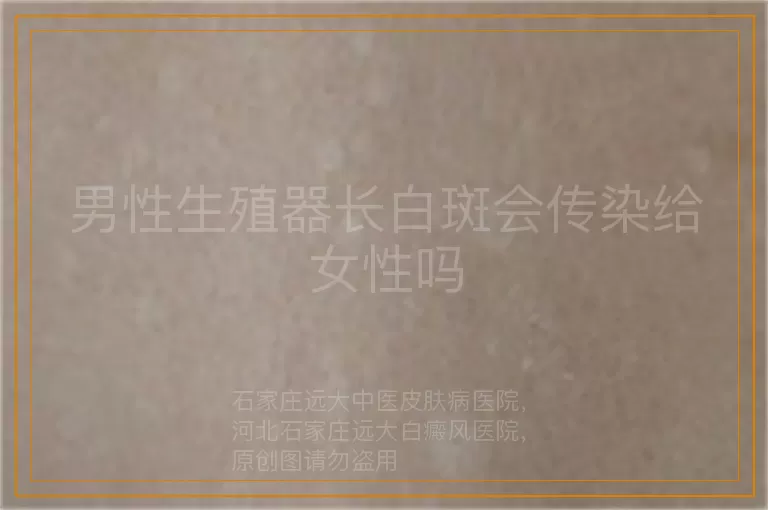 男性生殖器长白斑会传染给女性吗