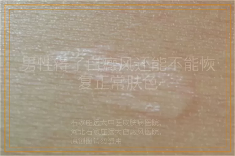 男性得了白癜风还能不能恢复正常肤色