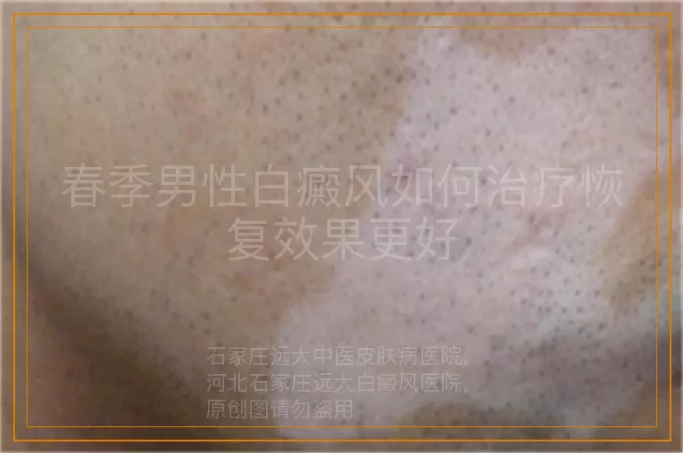 春季男性白癜风如何治疗恢复效果更好