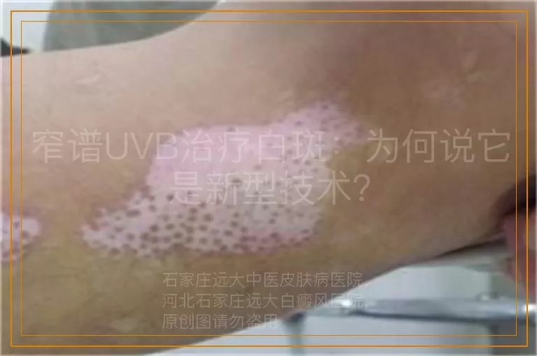 窄谱UVB治疗白斑：为何说它是新型技术？