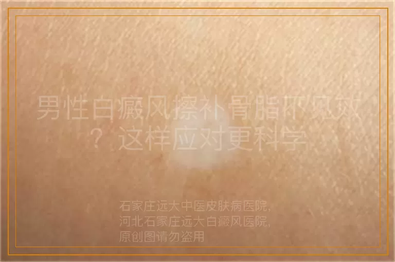 男性白癜风擦补骨脂不见效？这样应对更科学
