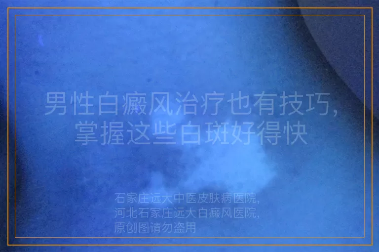 男性白癜风治疗也有技巧，掌握这些白斑好得快
