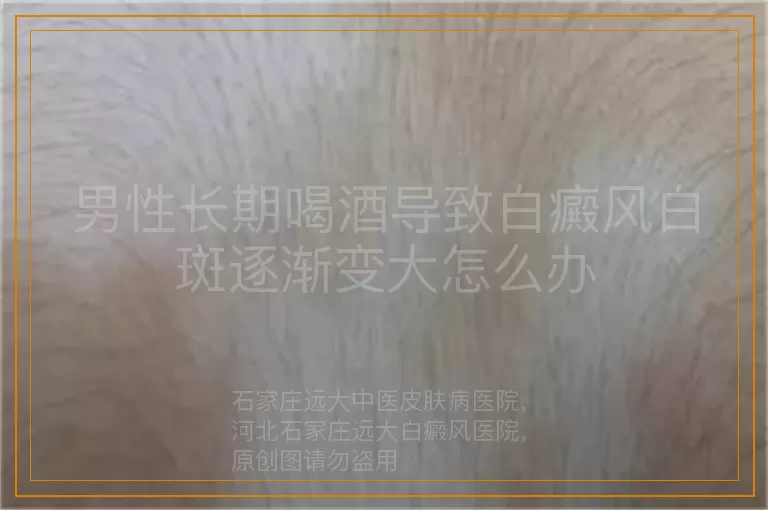 男性长期喝酒导致白癜风白斑逐渐变大怎么办