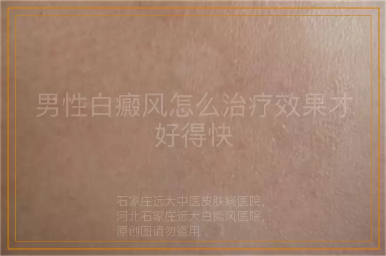 男性白癜风怎么治疗效果才好得快