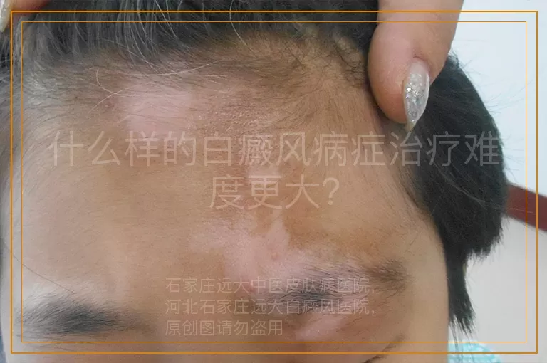 什么样的白癜风病症治疗难度更大？
