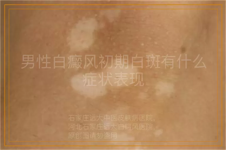 男性白癜风初期白斑有什么症状表现