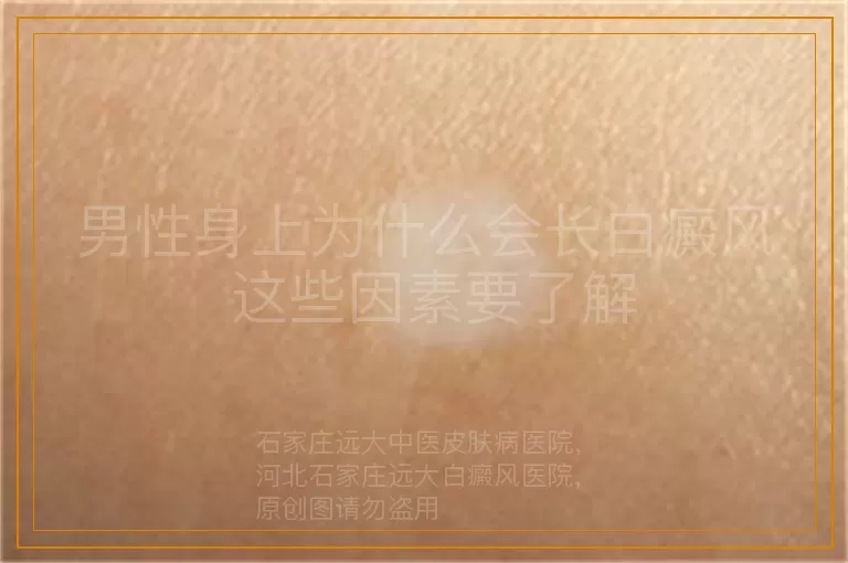 男性身上为什么会长白癜风 这些因素要了解