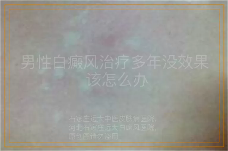 男性白癜风治疗多年没效果 该怎么办