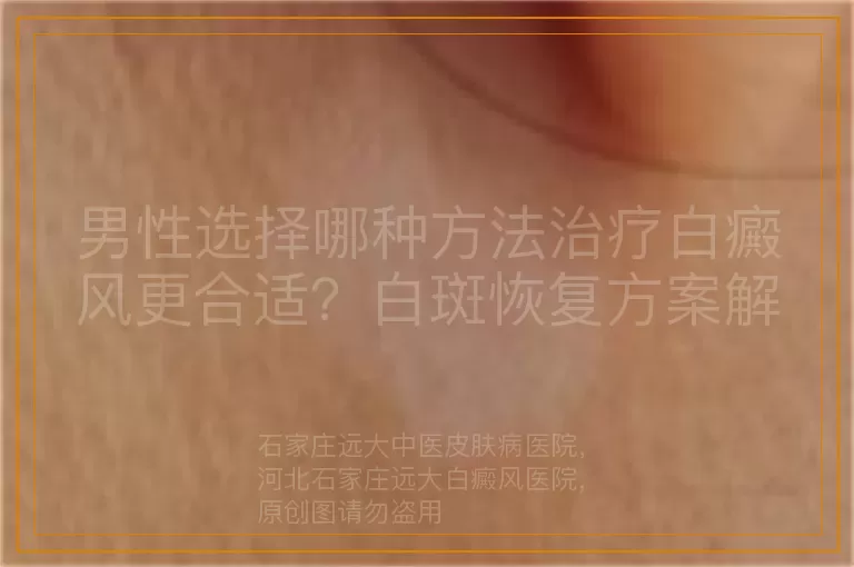 男性选择哪种方法治疗白癜风更合适？白斑恢复方案解析