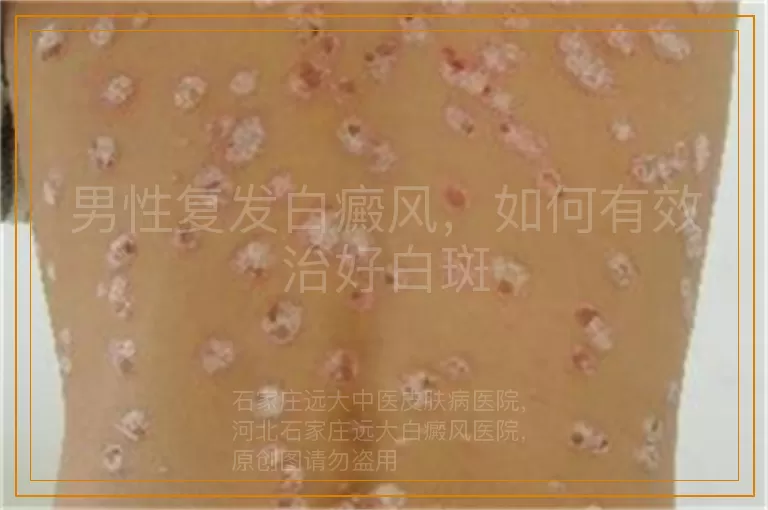 男性复发白癜风，如何有效治好白斑
