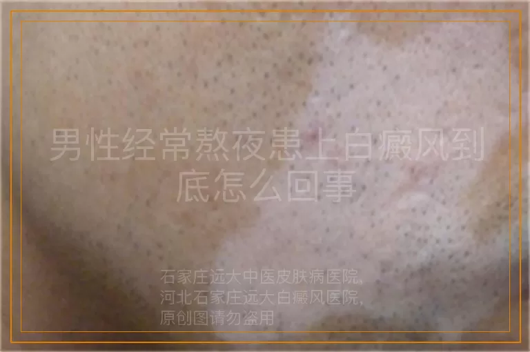 男性经常熬夜患上白癜风到底怎么回事