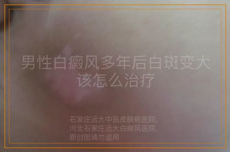 男性白癜风多年后白斑变大该怎么治疗