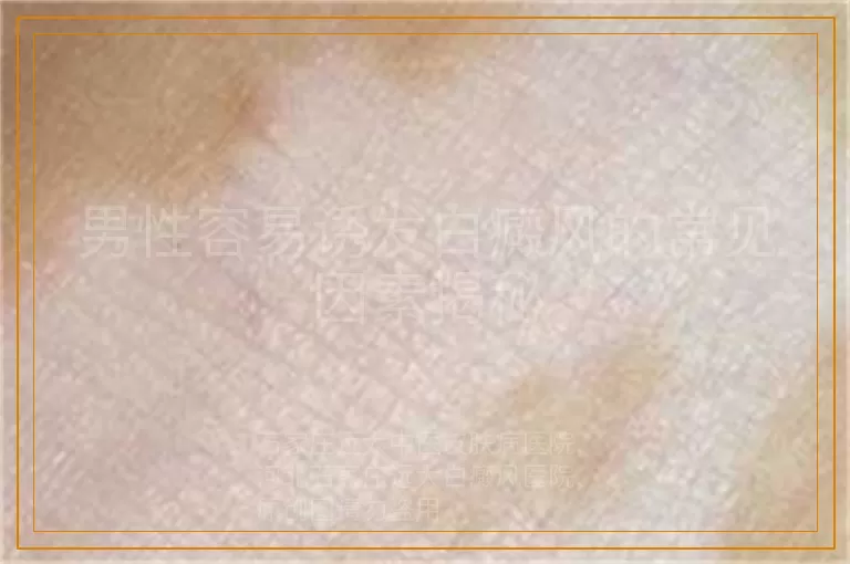 男性容易诱发白癜风的常见因素揭秘