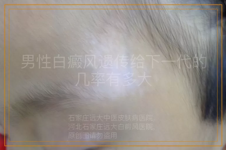 男性白癜风遗传给下一代的几率有多大