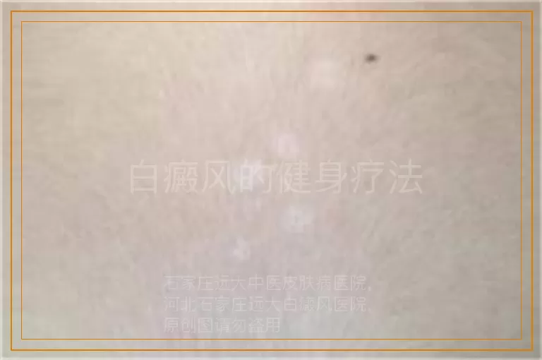 白癜风的健身疗法
