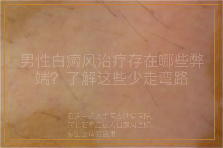 男性白癜风治疗存在哪些弊端？了解这些少走弯路