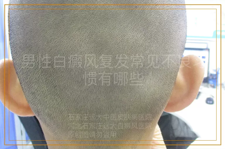 男性白癜风复发常见不良习惯有哪些