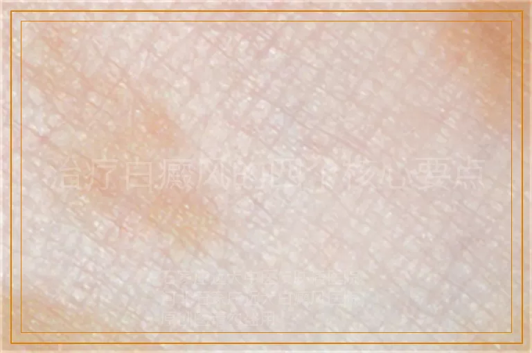 治疗白癜风的四个核心要点