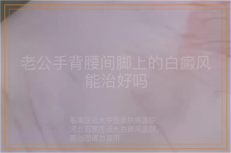 老公手背腰间脚上的白癜风能治好吗