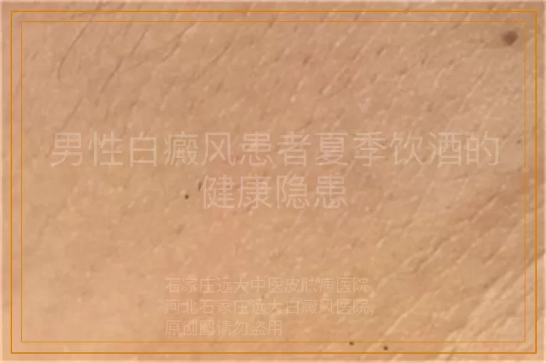 男性白癜风患者夏季饮酒的健康隐患