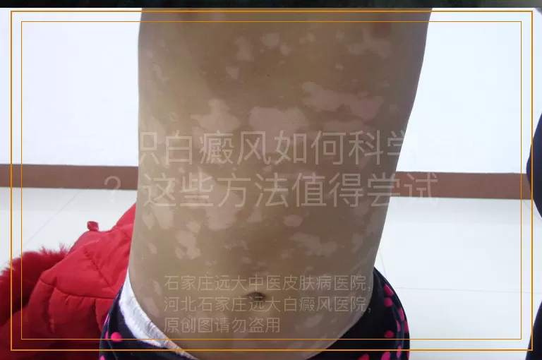 大面积白癜风如何科学治疗？这些方法值得尝试