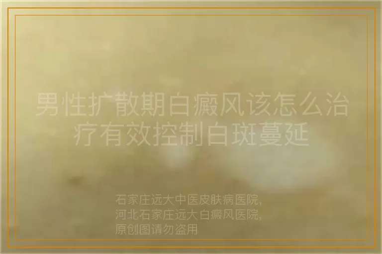 男性扩散期白癜风该怎么治疗有效控制白斑蔓延