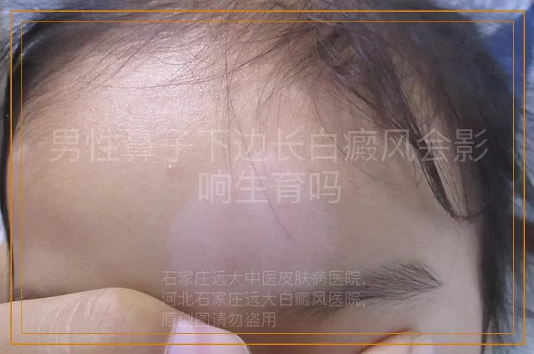 男性鼻子下边长白癜风会影响生育吗