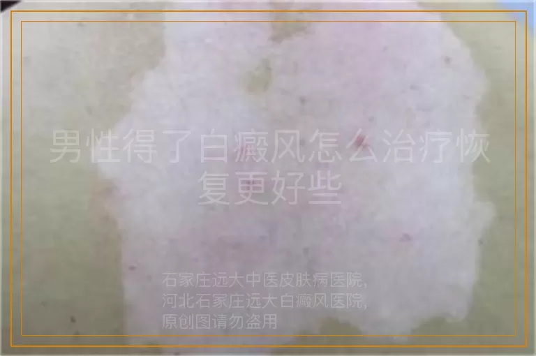 男性得了白癜风怎么治疗恢复更好些