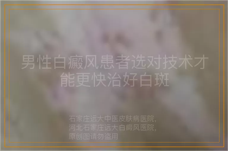 男性白癜风患者选对技术才能更快治好白斑