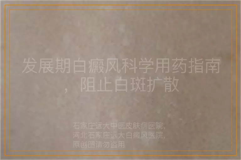 发展期白癜风科学用药指南，阻止白斑扩散