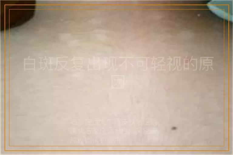 白斑反复出现不可轻视的原因