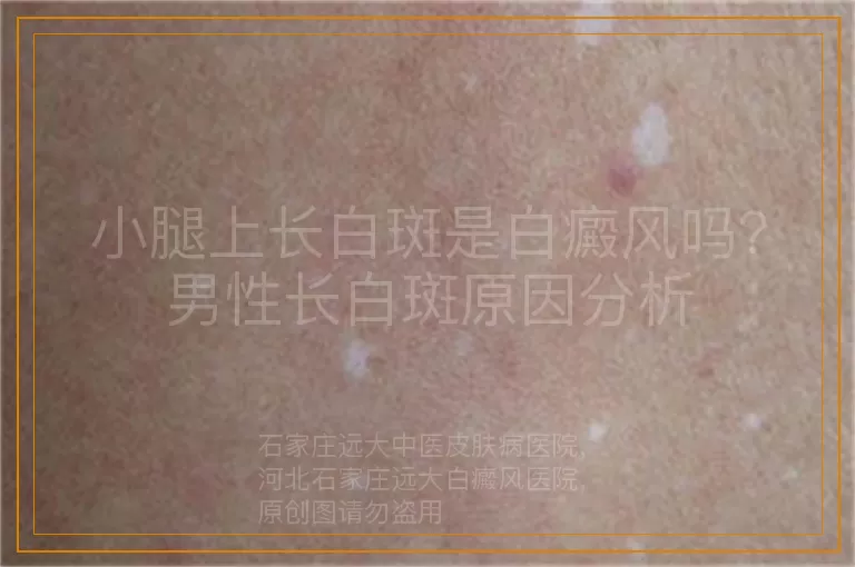小腿上长白斑是白癜风吗？男性长白斑原因分析
