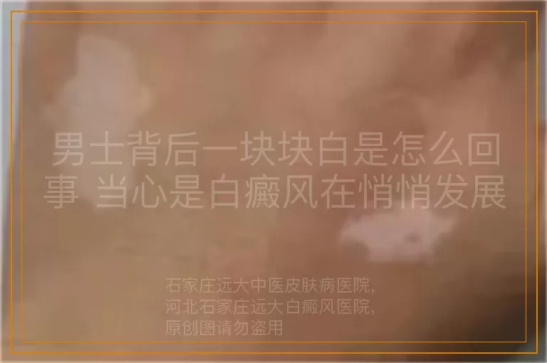男士背后一块块白是怎么回事 当心是白癜风在悄悄发展