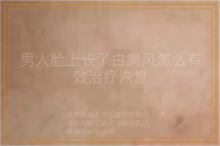 男人脸上长了白癜风怎么有效治疗恢复