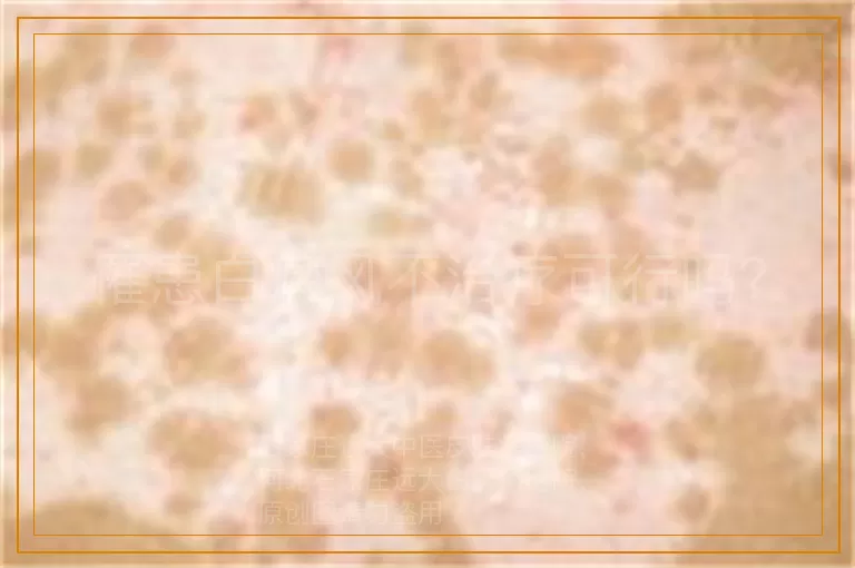 罹患白癜风不治疗可行吗？