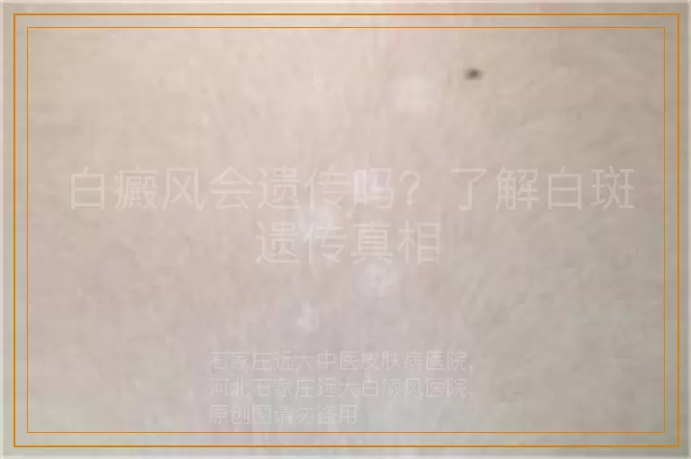 白癜风会遗传吗？了解白斑遗传真相