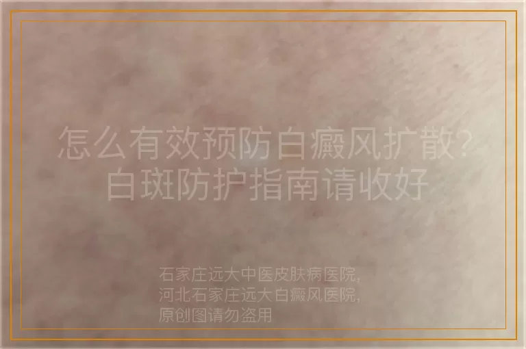 怎么有效预防白癜风扩散？白斑防护指南请收好