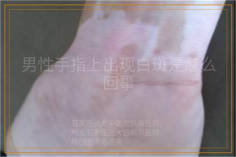 男性手指上出现白斑是怎么回事