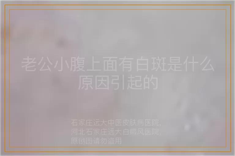 老公小腹上面有白斑是什么原因引起的