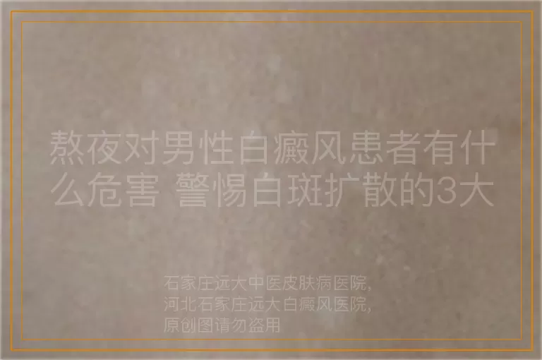 熬夜对男性白癜风患者有什么危害 警惕白斑扩散的3大不良影响