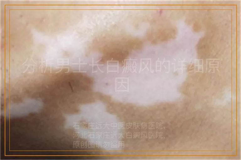 分析男士长白癜风的详细原因