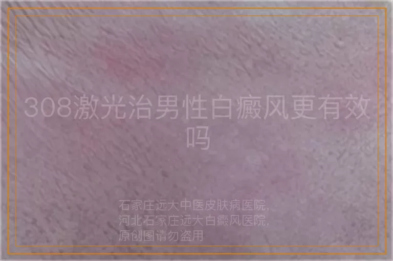 308激光治男性白癜风更有效吗