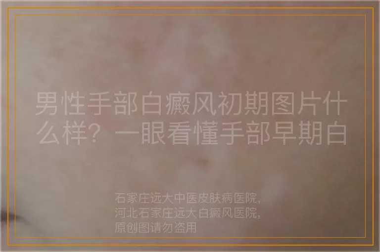 男性手部白癜风初期图片什么样？一眼看懂手部早期白斑特征