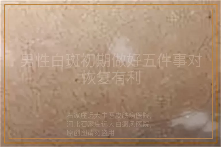 男性白斑初期做好五件事对恢复有利