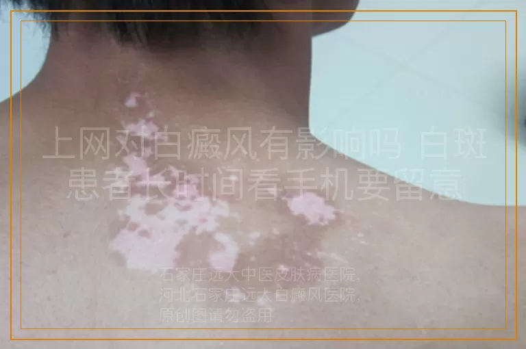 上网对白癜风有影响吗 白斑患者长时间看手机要留意