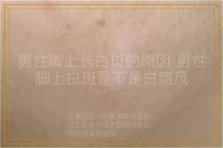 男性脚上长白斑的原因 男性脚上白斑是不是白癜风