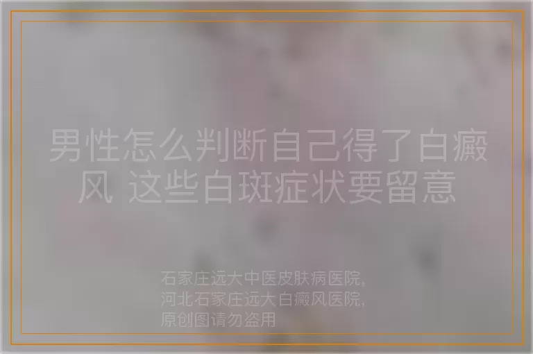 男性怎么判断自己得了白癜风 这些白斑症状要留意